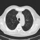 Panlobular emphysema: CT - Computed tomography